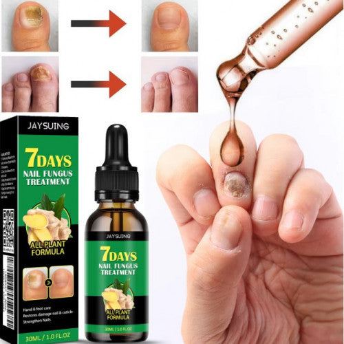 Tratamiento para Hongos en Uñas – Pies y Manos (30 ml)